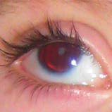 Aniridie-Auge